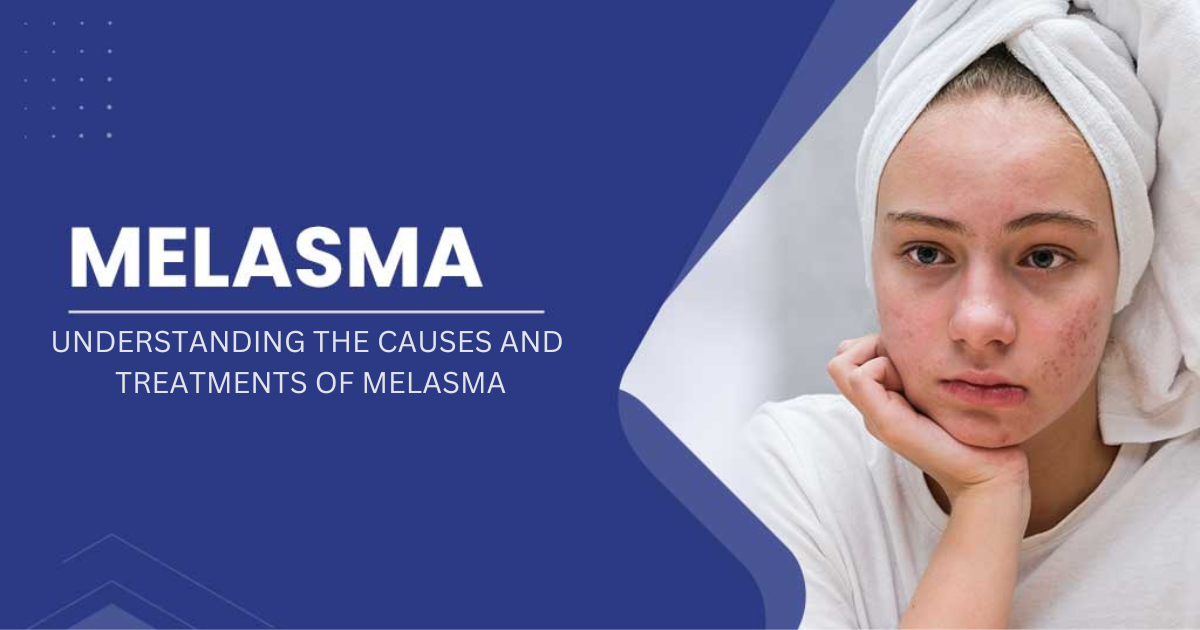 Understanding the causes and treatments of melasma